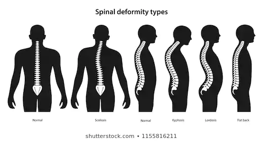 spinal-deformity-types