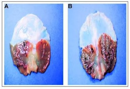 Calcified Pineal Gland.jpg